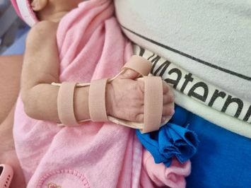 NMDER inicia produção de órteses de material termoplástico para bebês prematuros